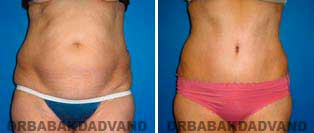 Tummy Tuck: Before and After Photos. 59 year old female - front view