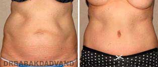 Tummy Tuck: Before and After Photos. 58 year old female - front view