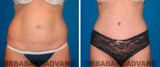 Tummy Tuck: Before and After Photos. 35 year old female - front view