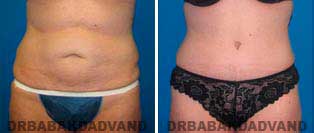 Tummy Tuck: Before and After Photos. 46 year old female - front view