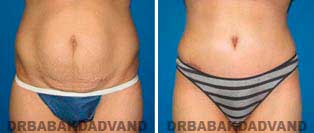 Tummy Tuck: Before and After Photos. 44 year old female - front view