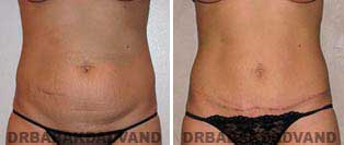Tummy Tuck: Before and After Photos. 28 year old female - front view