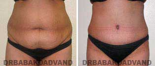 Tummy Tuck: Before & After Photos. 33 year old female - front view