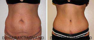 Tummy Tuck: Before & After Photos. 44 year old female - front view
