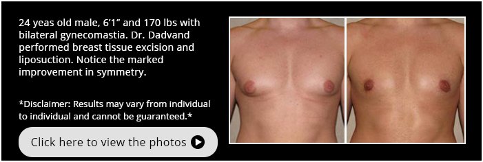 Gynecomastia. Before and After Photos. 