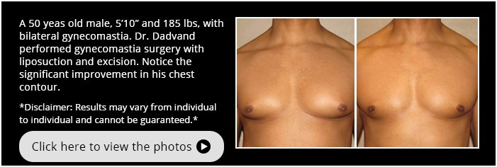 Gynecomastia. Before and After Photos. 