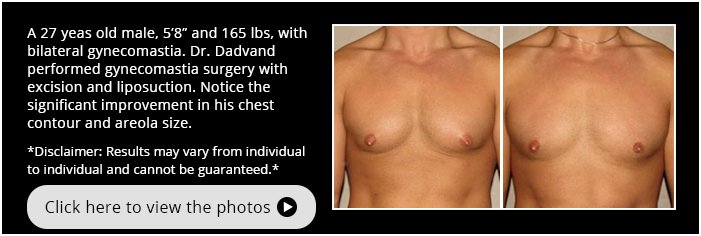 Gynecomastia. Before and After Photos. 27 year old male. Frontal view 
