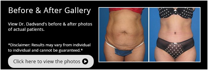 Tummy Tuck. Before and After Gallery
