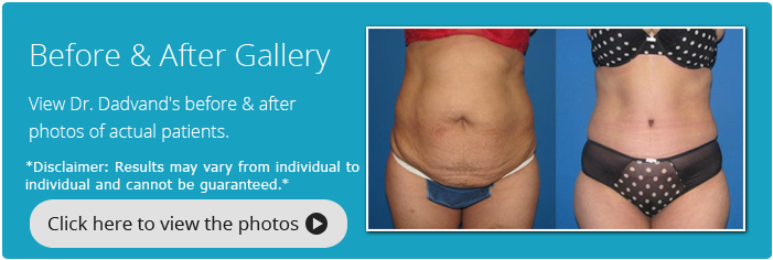 Tummy Tuck. Before and After Gallery