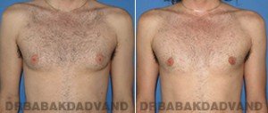 Before and After Photos. Gynecomastia. 40 year old. Male - front view