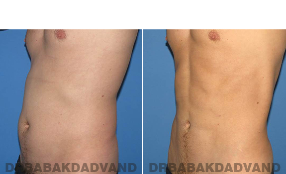 Before and After Photos. Vaser Liposaction