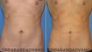 Vaser Liposaction Before & After Photos. Male