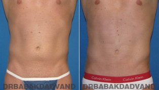 Vaser Liposaction Before & After Photos. Male