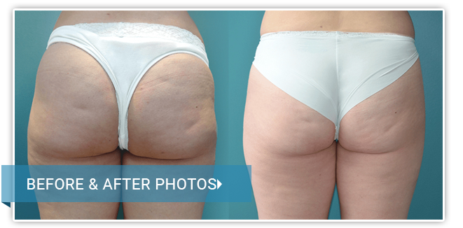 Liposuction. Before and After photos female front view
