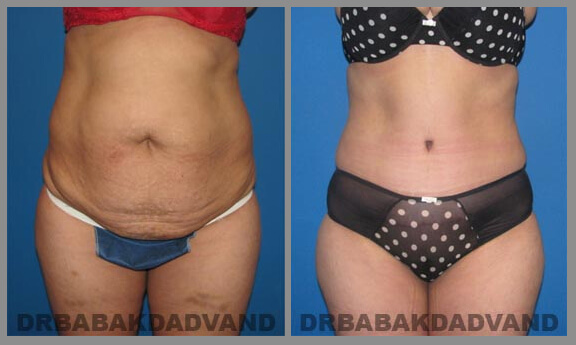 Tummy Tuck. Before and After Gallery