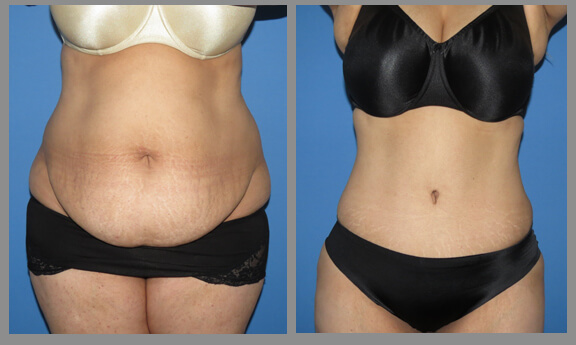 Tummy Tuck. Before and After Gallery2