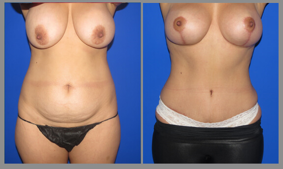 Tummy Tuck. Before and After Gallery3