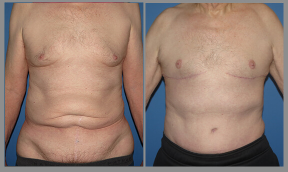 Tummy Tuck. Before and After Gallery4