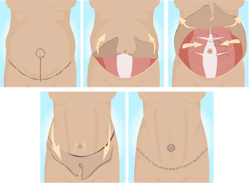 Traditional Tummy Tuck