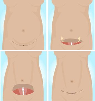 Traditional Tummy Tuck