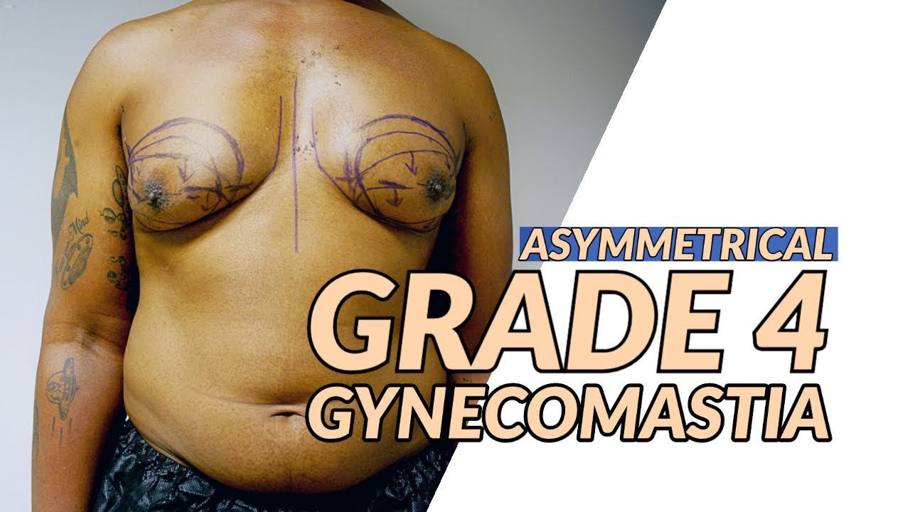 Grade 4 Asymmetrical Gynecomastia Surgery by Dr.Dadvand