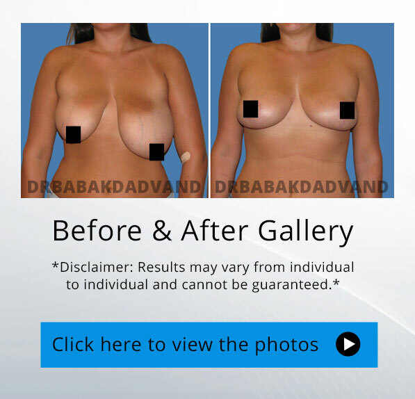 Grade 2 and 3 Asymmetric Gynecomastia Steroid Induced with Dr.Dadvand