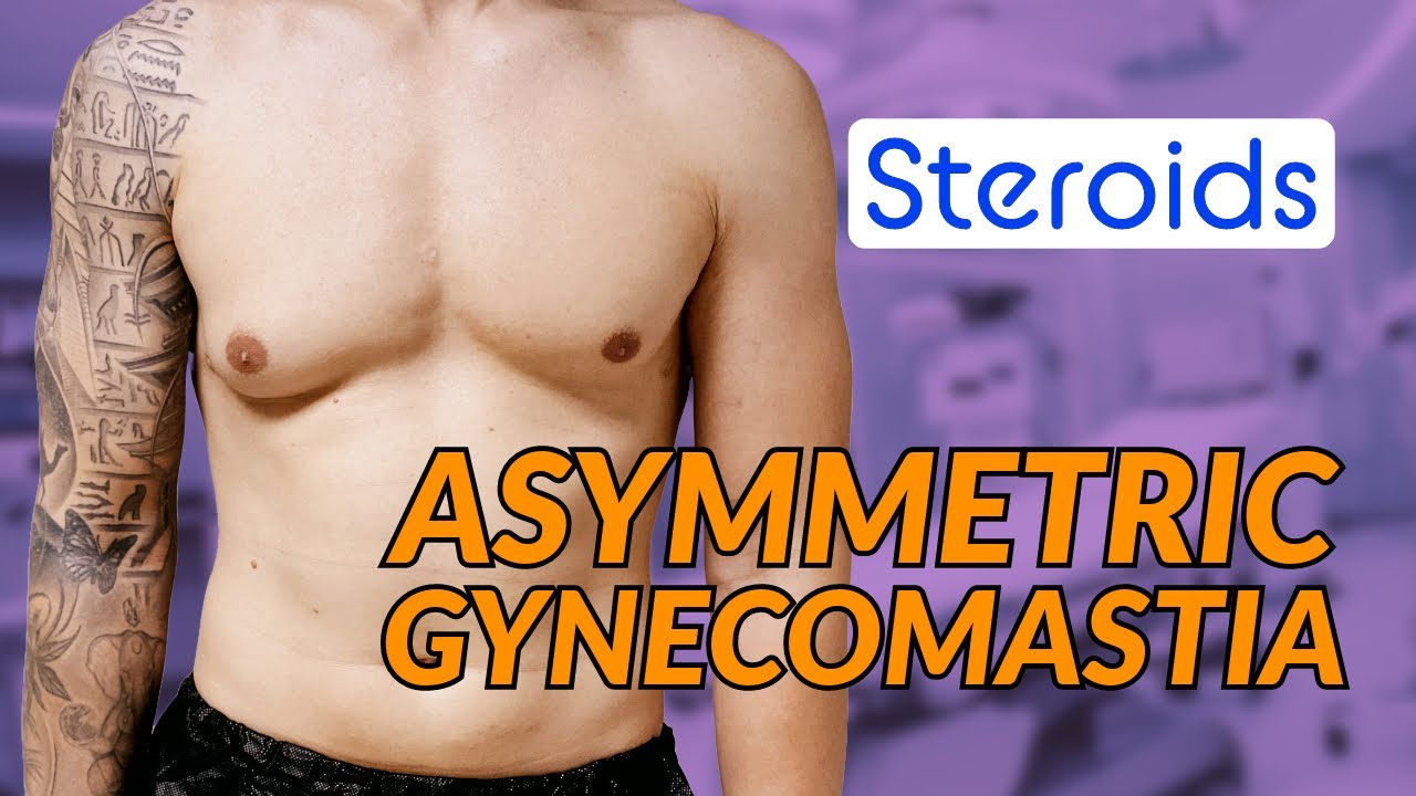 Grade 2 and 3 Asymmetric Gynecomastia Steroid Induced with Dr.Dadvand